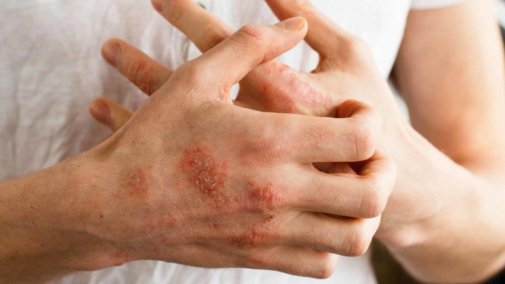 Eczema-psoriasis-skin-disease-red-itchy-patches-dry-cracked-bumps-natural-remedies